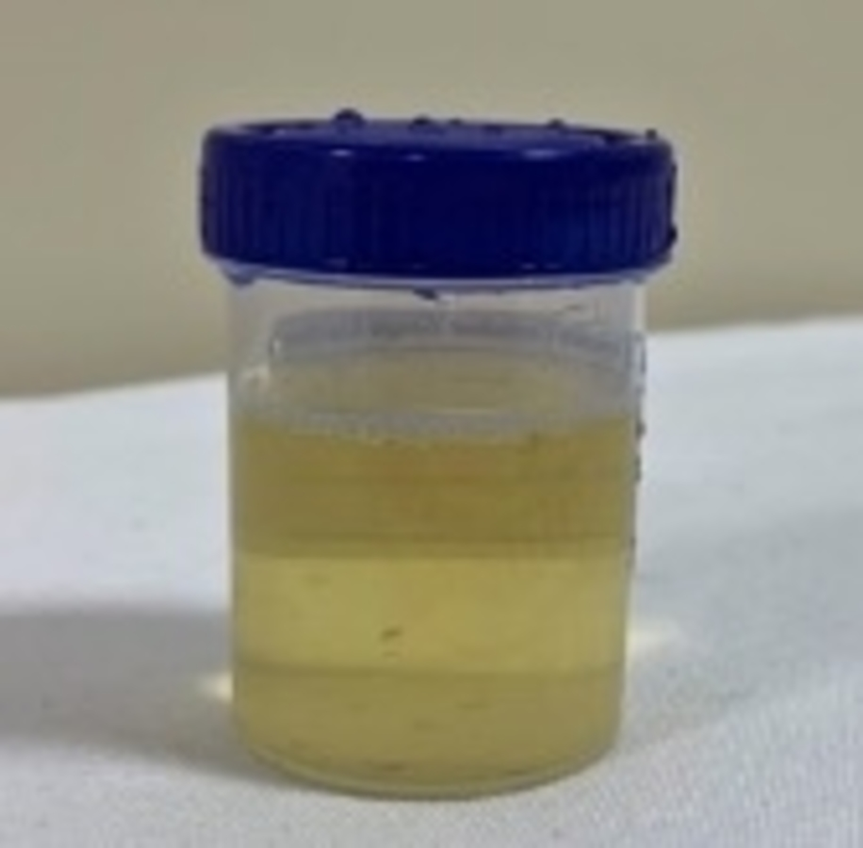 Cloudy Urine In Morning Child