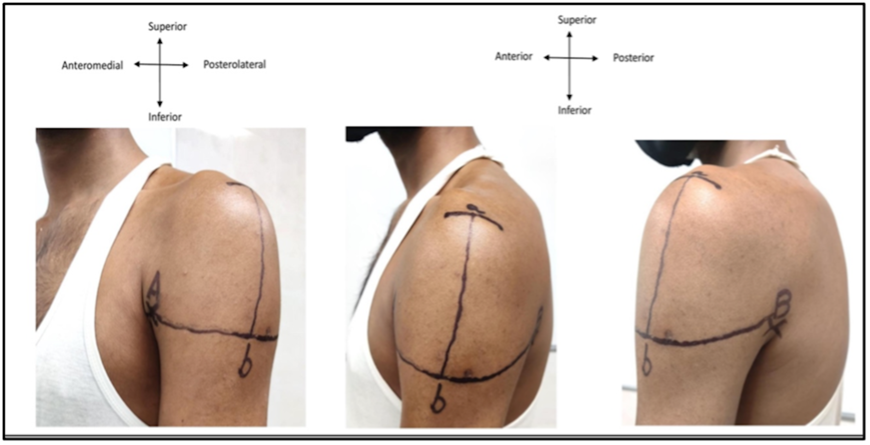 Deltoid Muscle Injection