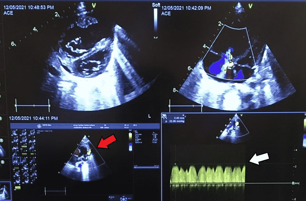 Pre-procedural-transthoracic-echocardiogram-showing-dilated-right-heart,-moderate-tricuspid-regurgitation,-and-severe-pulmonary-hypertension.