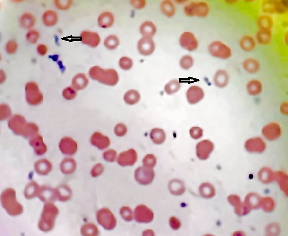 Cureus Severe Babesiosis With Heavy Parasitemia In An Immunocompetent Patient Treated