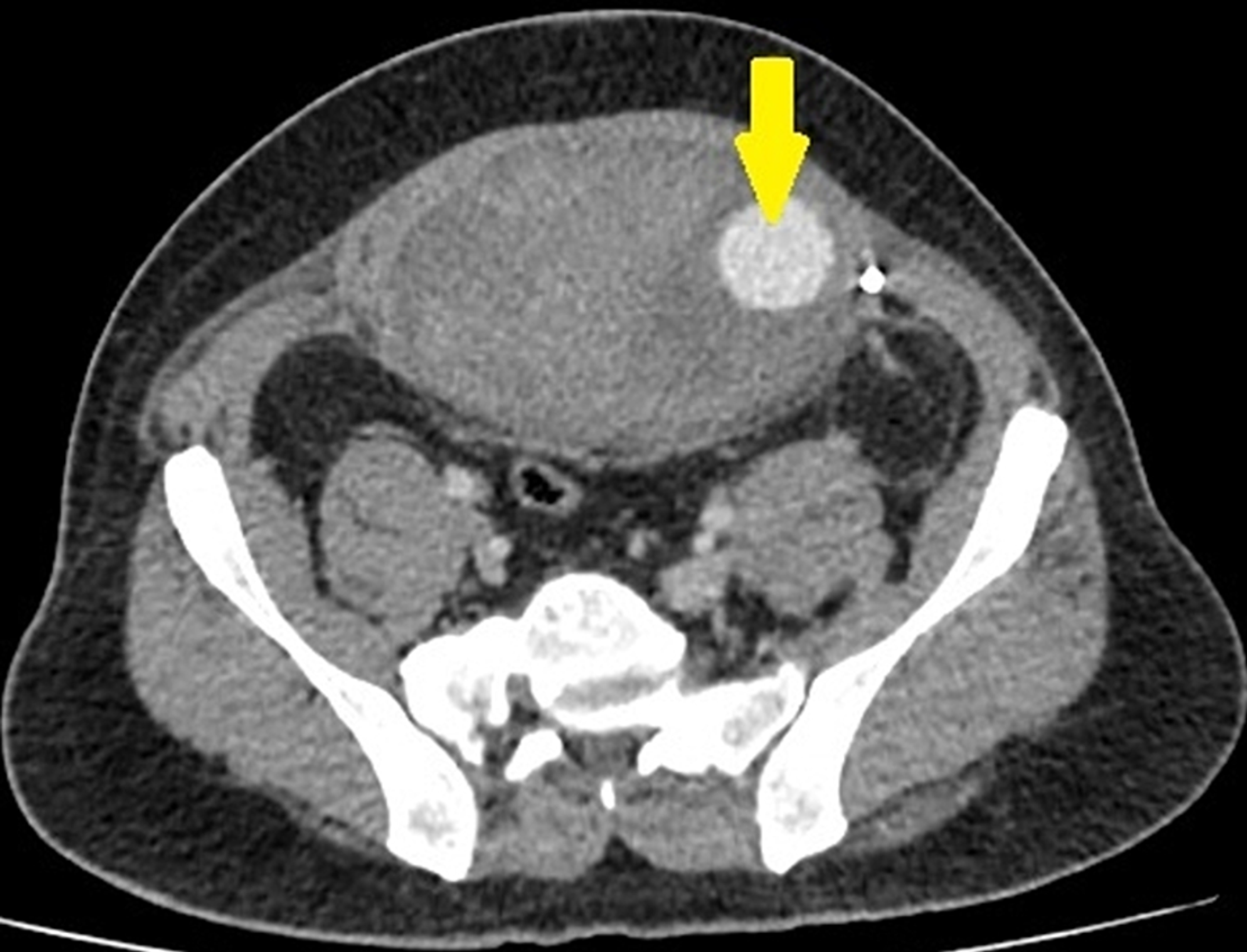 inferior epigastric region is