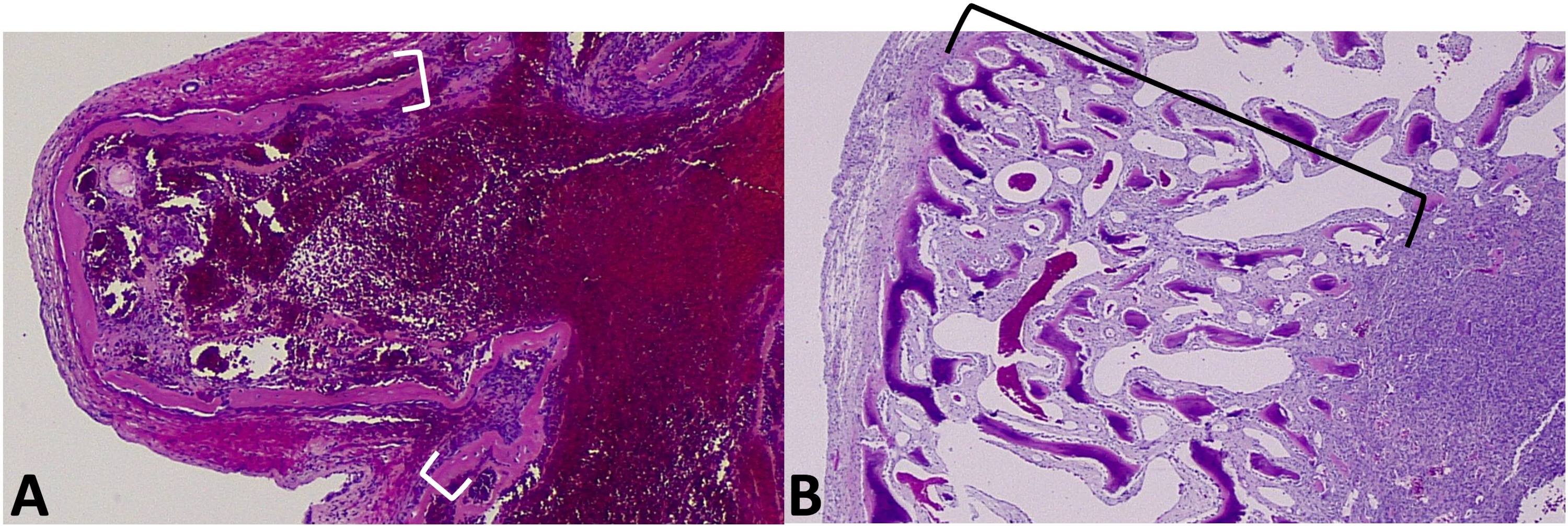 aneurysmal bone cyst jaw histology