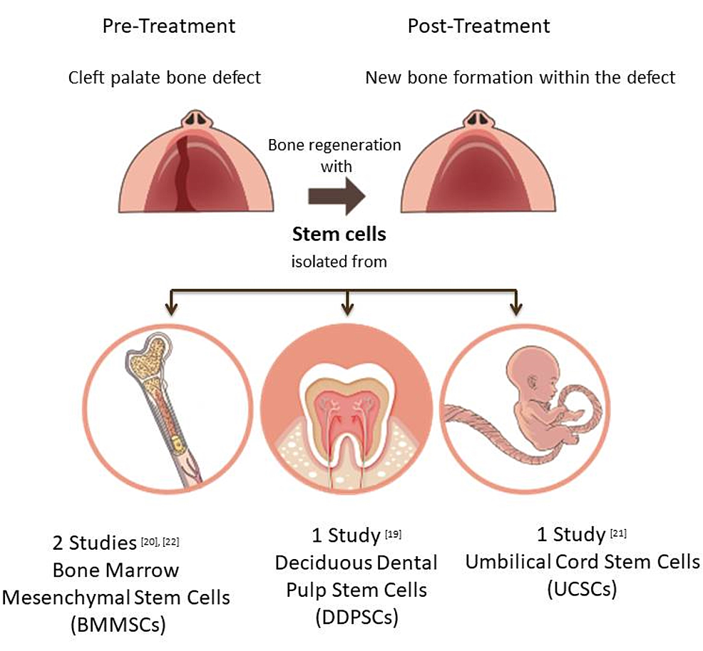 Sources-of-stem-cells-used-in-alveolar-cleft-defect-reconstruction