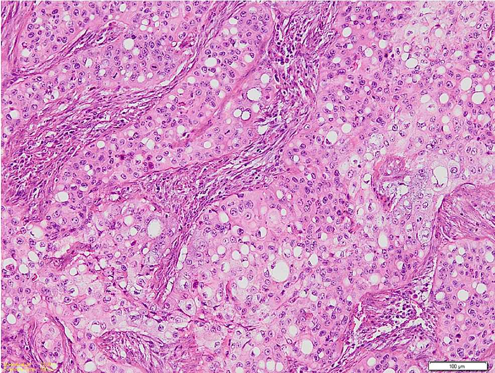 Photomicrograph-shows-numerous-neoplastic-cells-having-signet-ring-shaped-with-clear-cytoplasm-and-eccentrically-placed-nucleus
