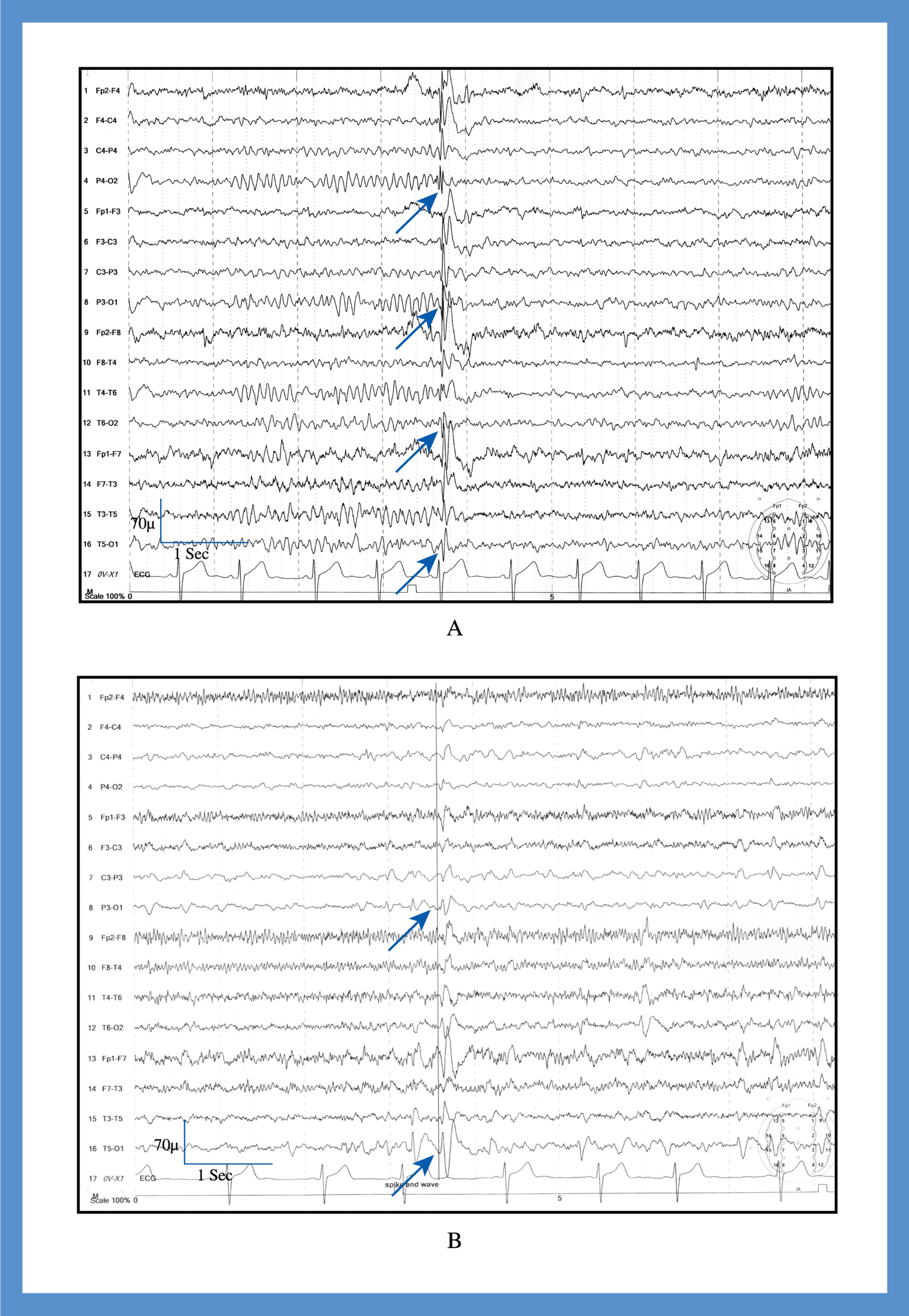 Cureus Presentation Etiology Outcome And Differentiation Of Visual Semiology Of Adult Occipital Epilepsy From Visual Aura Of Migraine Headache A Prospective Study In A Tertiary Care Center In Bangladesh