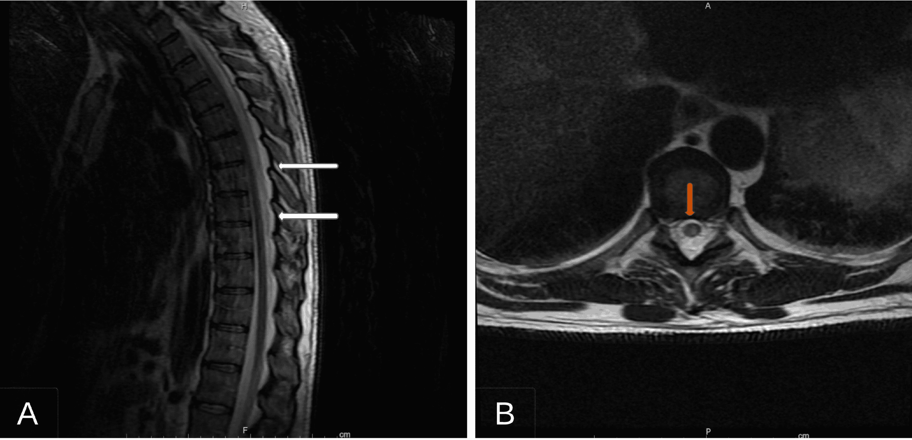 Cureus Nitrous Oxide/WhippitsInduced Thoracic Spinal Cord Myelopathy