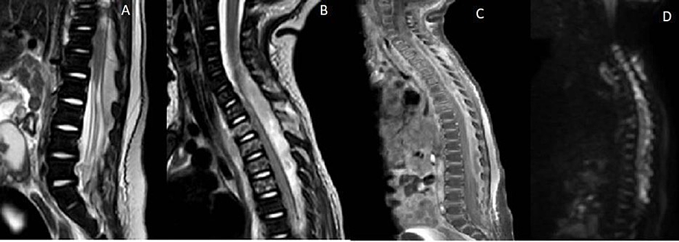 T2-Sagittal-MRI-of-the-thoracolumbar-(A)-and-cervicothoracic-(B)-regions-demonstrate-posterior-epidural-collection-causing-significant-cord-compression.-Post-contrast-(C)-and-DWI-(D)-imaging-confirm-the-diagnosis-of-spinal-epidural-abscess.