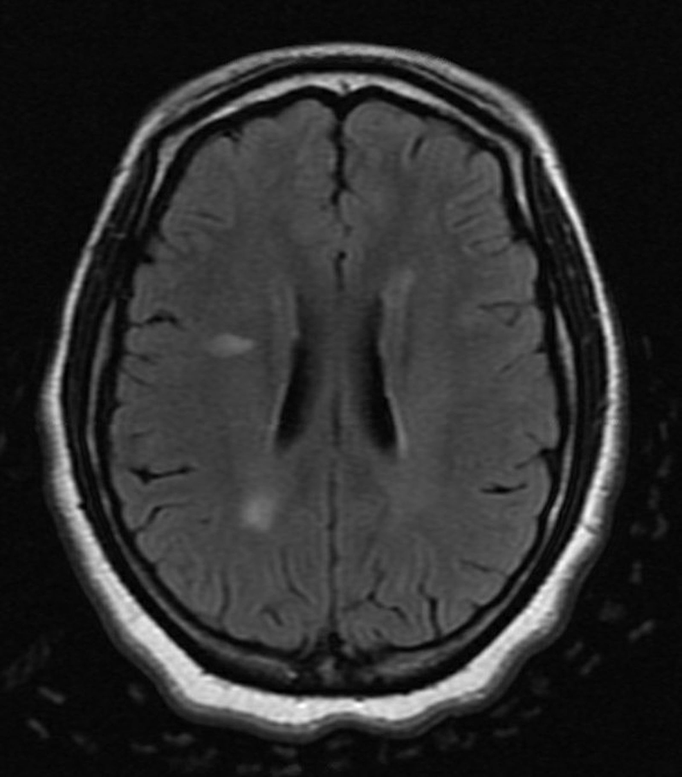 Para and Post-COVID-19 CNS Acute Demyelinating Disorders in Children: A ...