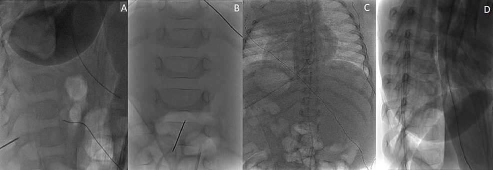 Lateral-(A)-and-posteroanterior-(B)-radiographs-demonstrating-needle-placement-at-the-L2-3-interspace.-Confirmatory-posteroanterior-(C)-and-lateral-(D)-radiographs-demonstrate-the-epidural-catheter-extending-up-to-approximately-the-T7-level.