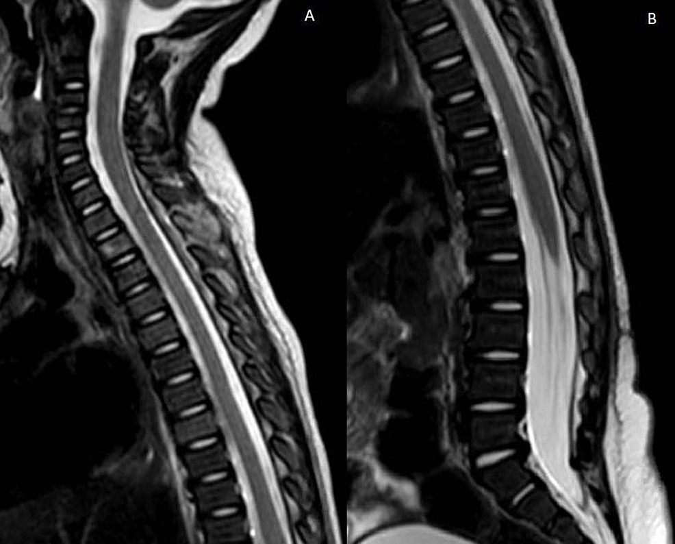 Three-week-postoperative-T2-MRI-of-the-cervicothoracic-(A)-and-thoracolumbar-(B)-regions-demonstrate-near-complete-resolution-of-the-spinal-epidural-abscess.