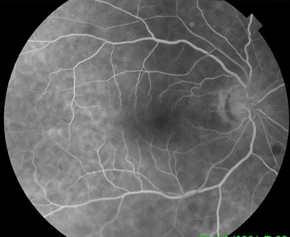 -FFA-of-the-right-eye-shows-a-normal-angiogram.