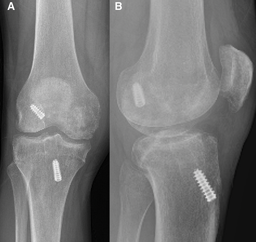 (a)-Anteroposterior-and-(b)-lateral-radiographs-of-the-right-knee-of-a-29-year-old-man-(patient-three)-with-previous-anterior-cruciate-ligament-reconstruction-and-a-medial-femoral-condyle-lesion.