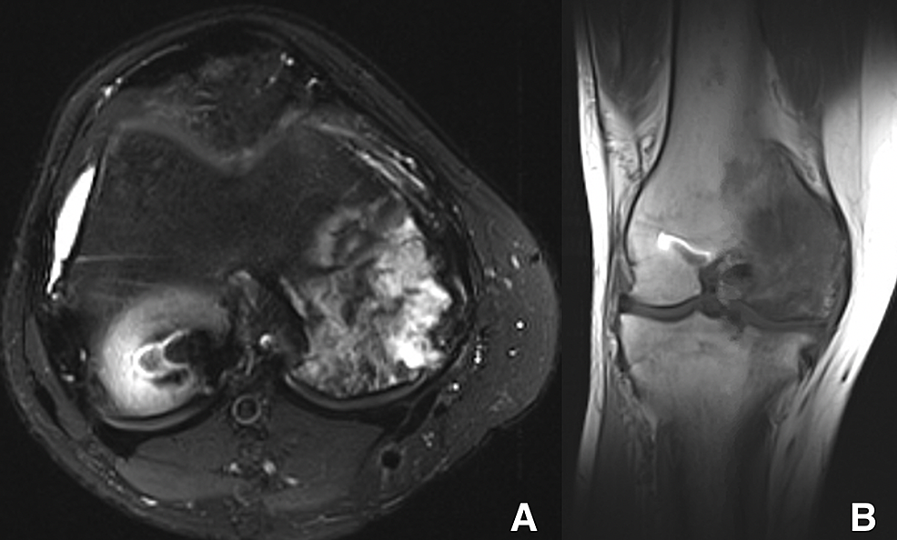(a)-T2-weighted-fat-suppressed-axial-and-(b)-T1-weighted-coronal-magnetic-resonance-images-of-the-right-knee-of-a-29-year-old-man-(patient-three)-showing-heterogeneity-and-hyperintensity-on-T2-weighted-signal-within-the-medial-femoral-condyle.