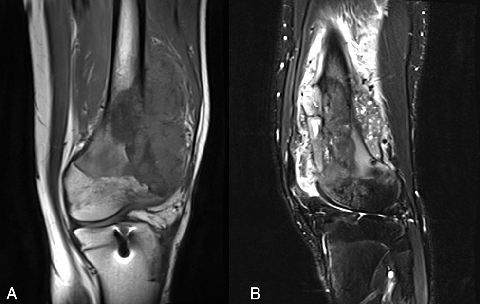 (a)-T1-weighted-coronal-and-(b)-T2-weighted-fat-suppressed-sagittal-magnetic-resonance-images-of-the-left-knee-of-a-16-year-old-boy-(patient-four).-Images-show-a-T1-weighted-hypointense-and-T2-weighted-heterogenous-lobulated-mass-involving-the-distal-femoral-metaphysis-and-lateral-condyle-after-anterior-cruciate-ligament-reconstruction.