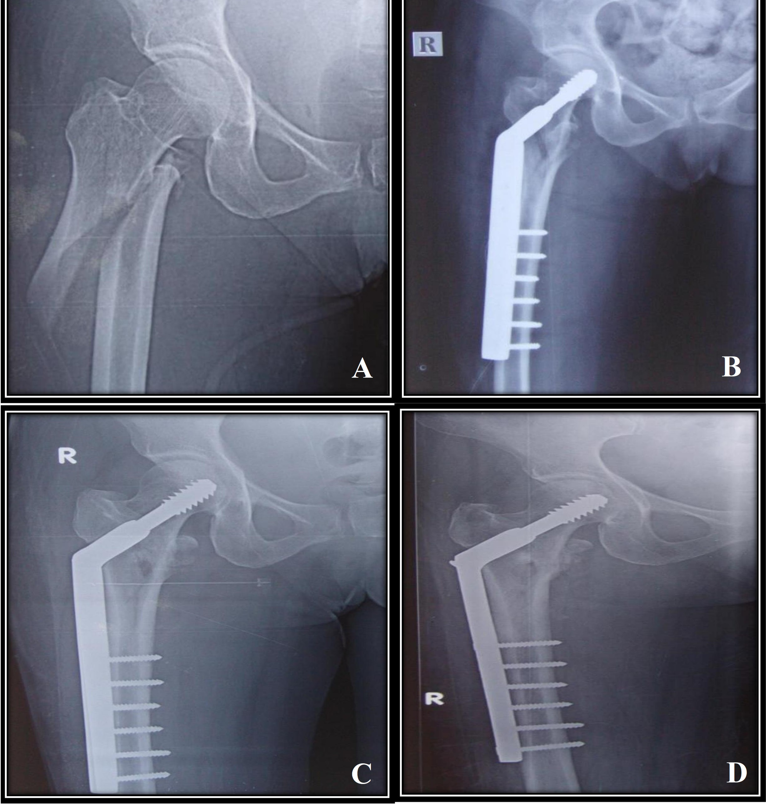 Cureus | A Comparative Study of Functional Outcome Following Dynamic Hip  Screw and Proximal Femoral Nailing for Intertrochanteric Fractures of the  Femur | Article