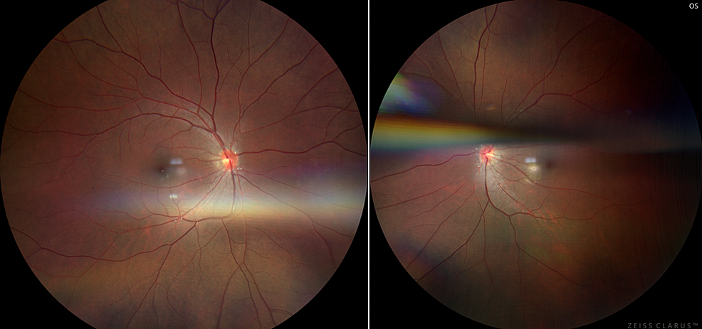 OD-(left-image)-and-OS-(right-image)-color-funduscopy-images.-Photos-show-clear-vitreous,-pink-sharp-and-flat-nerve,-attached-and-dry-macula,-vessels-without-attenuation,-and-retina-attached-without-pigment-set-changes.-The-OS-image-also-includes-an-artifact.