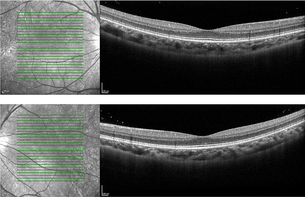 OD-(image-above)-and-OS-(image-below)-OCT-images-showing-the-macula-with-normal-retinal-architecture-without-intraretinal-or-subretinal-fluid.