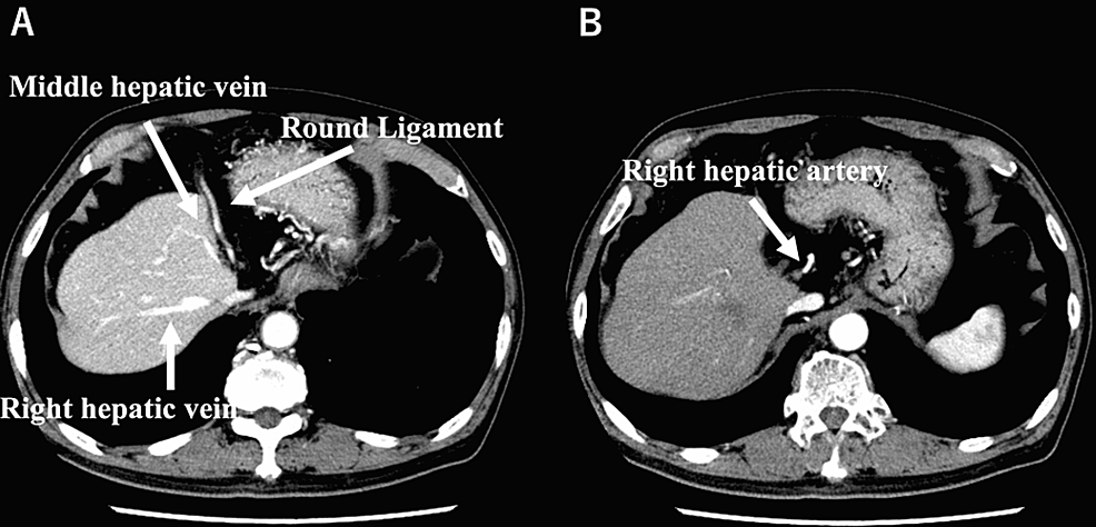 Abdominal-CT-scan-with-contrast-showing- (A) -absence-of-the-left-hepatic-lobe-in-the-late-phase-and- (B) -absence-of-the-left- hepatic-artery-in-the-arterial-phase.
