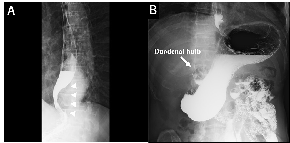 Upper-gastrointestinal-series-representing- (A) -barium-translucency-at-the-esophagogastric-junction .- (B) -Gastric-volvulus-and-high-positioning-of-the-duodenal-bulb-were-ruled -out.