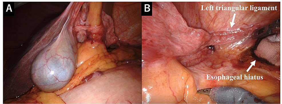 Intraoperative-findings-revealing- (A) -agenesis-of-the-left-hepatic-lobe-with-no-cirrhosis-of-the-right-hepatic-lobe.- (B) -The-caudate-lobe-was -absent.