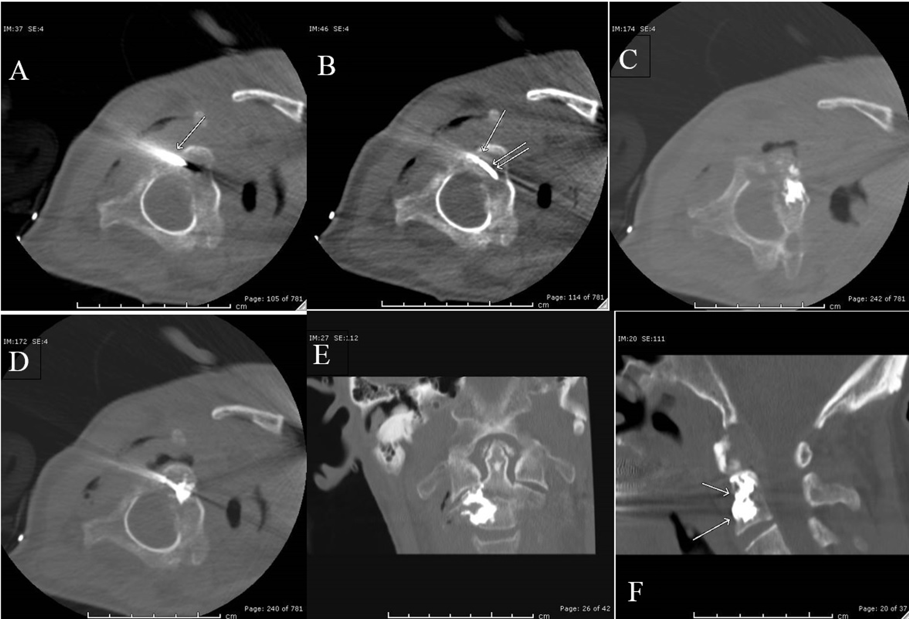 Vertebroplasty of C2 Pathologic Fracture: A Unique Case Report Using a ...