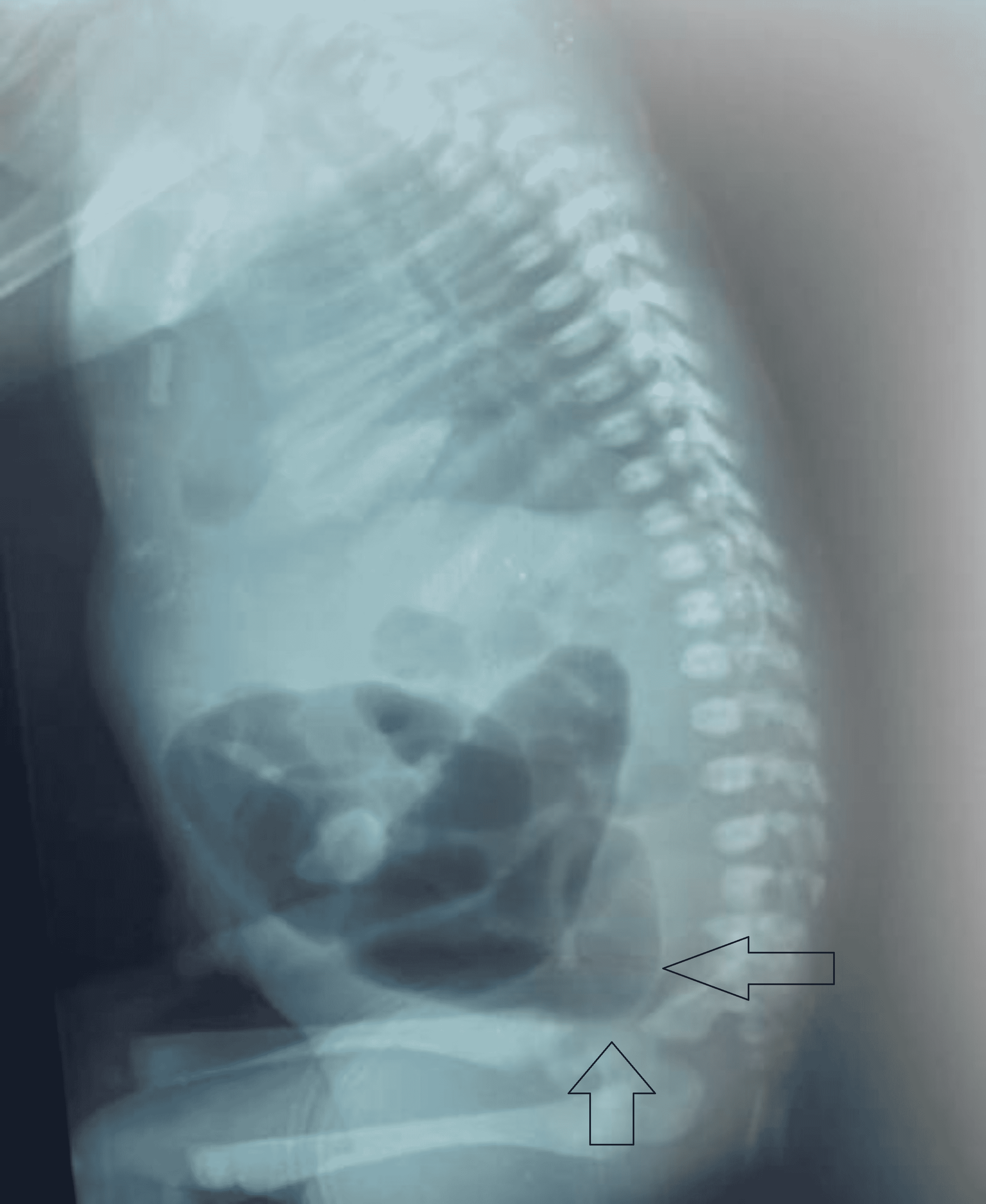 Cureus | Type 4 Ileal Atresia and Anorectal Malformation in a Neonate: A  Rare Association