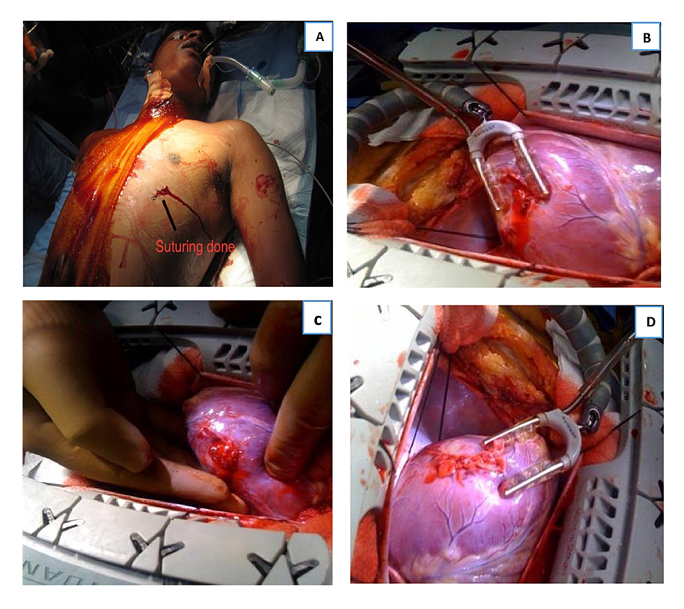 Stab-wound-on-the-anterior-aspect-of-the-left-side-of-the-chest-(A).-Intraoperative-picture-showing-tear-in-the-lateral-wall-of-the-left-ventricle-between-the-LAD-and-OM-territory-(B,-C)-and-after-the-repair-of-the-tear-with-Teflon-felt-pledgetted-sutures-(D).