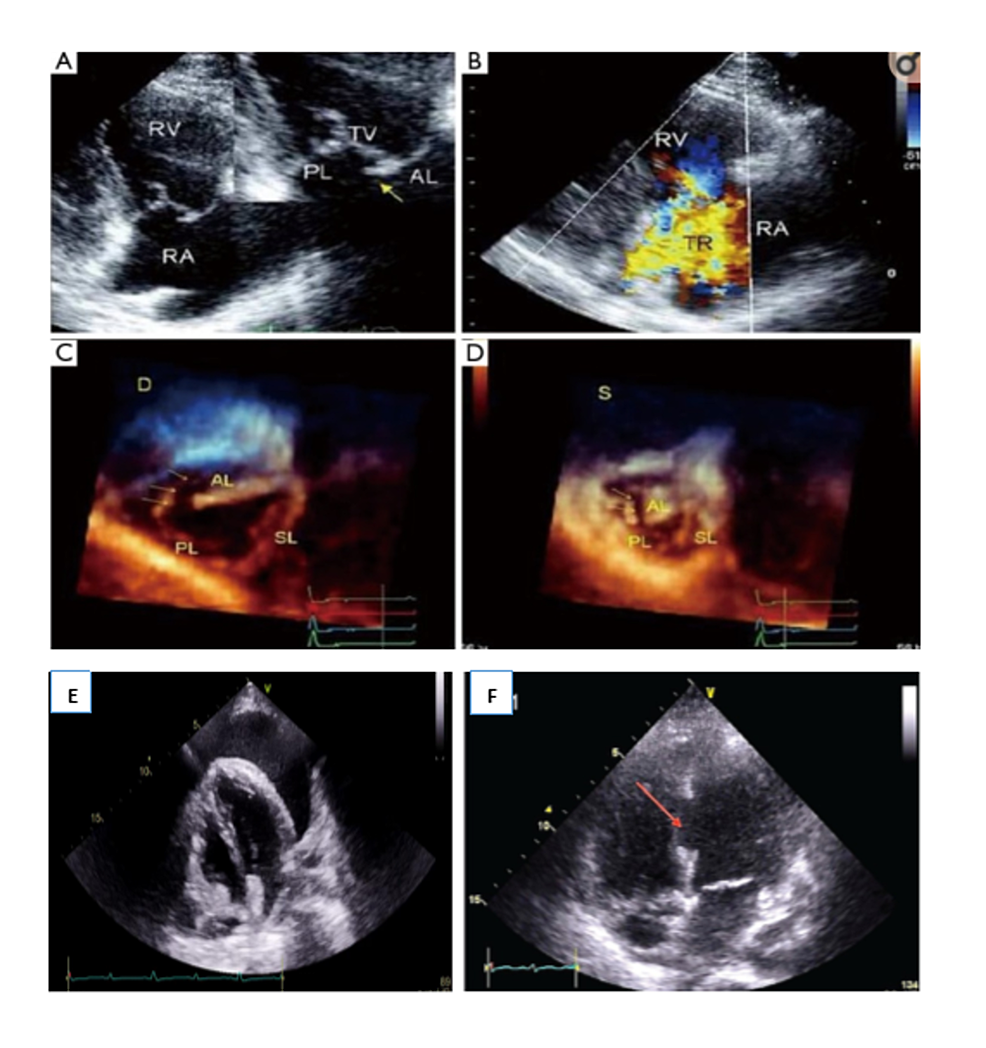 Transthoracic-echocardiogram-showing-tricuspid-valve-injury-(A,-C,-D),-severe-TR-(B),-pericardial-effusion-(E),-and-ventricular-septal-defect-red-arrow-(F).