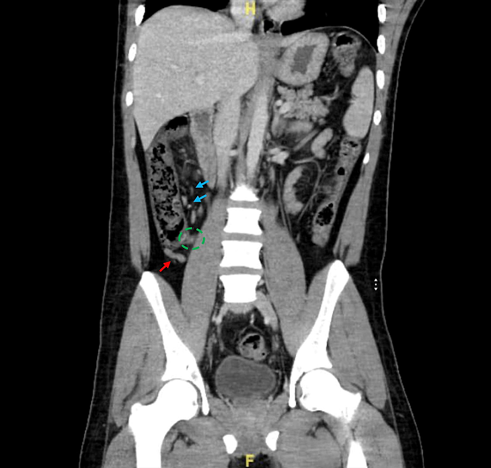 CT-of-the-abdomen-with-contrast