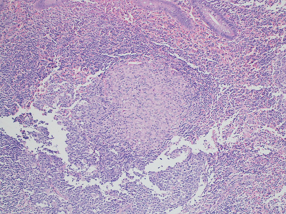 Histology-of-surgical-specimen:-Epithelioid-granuloma