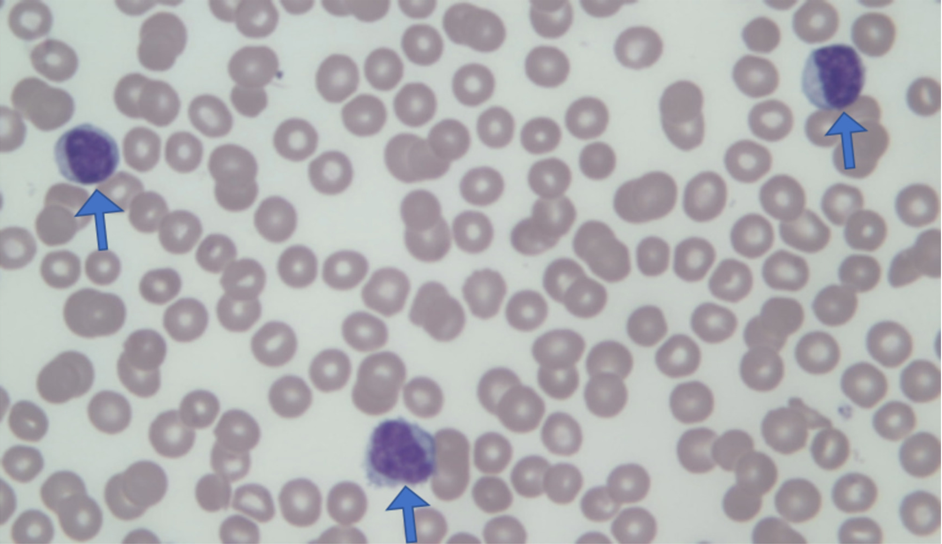 lgl leukemia icd 9 code