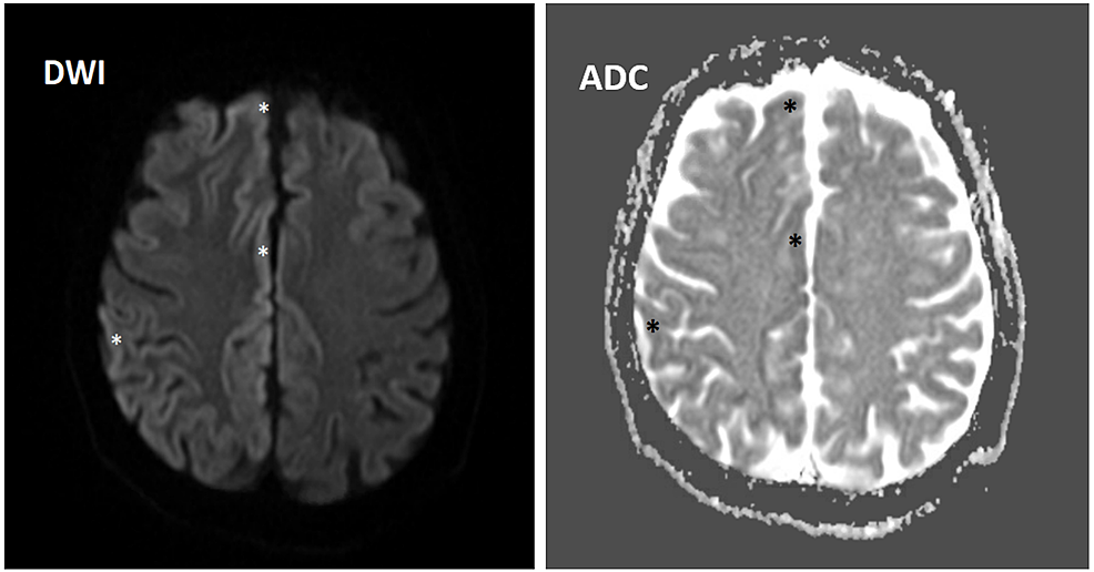 MRI-of-the-brain-showing-diffusion-restriction-areas-within-the-cortical-sulci-of-the-right-frontal-and-parietal-lobes-(asterisks)-in-both-DWI-and-ADC-sequences.