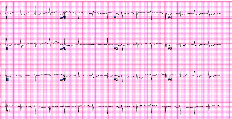 Sinus-rhythm-with-non-specific-ST-T-wave-abnormalities