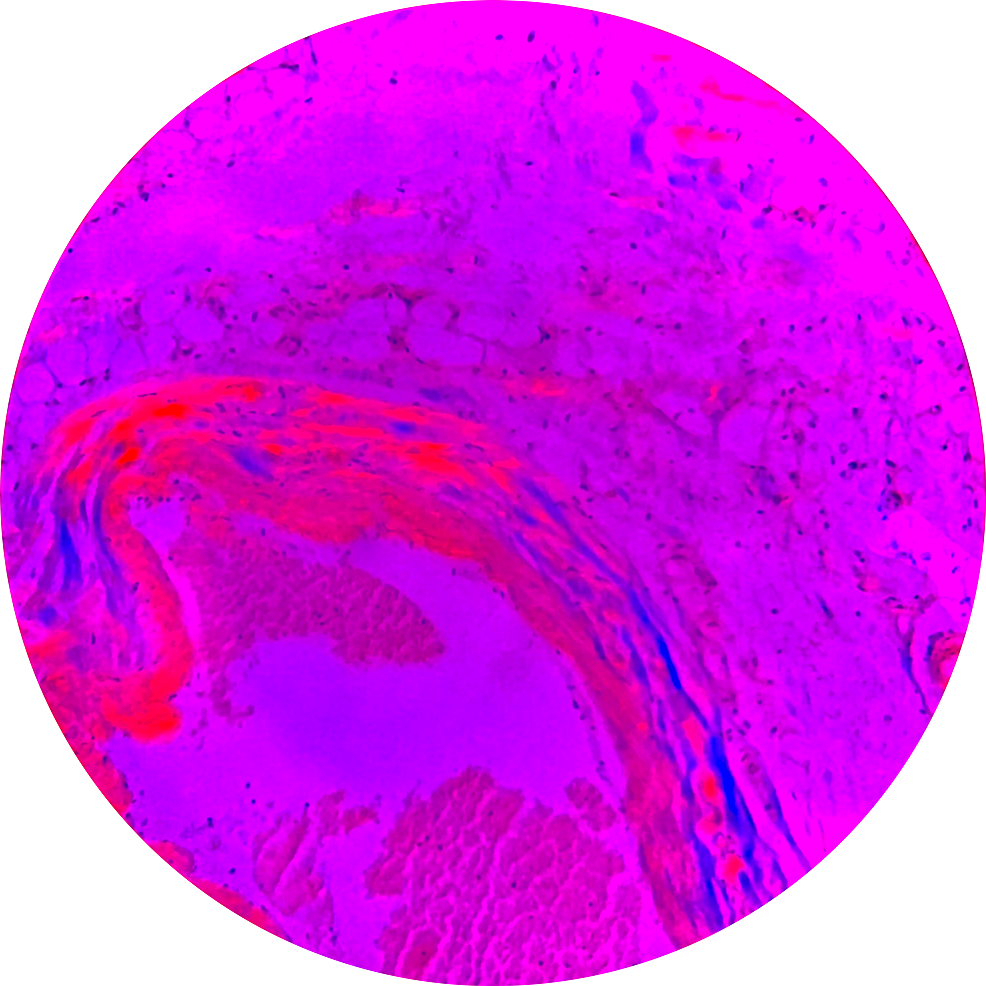 Congo-red-stain-positive-amyloid-areas-in-bright-pink