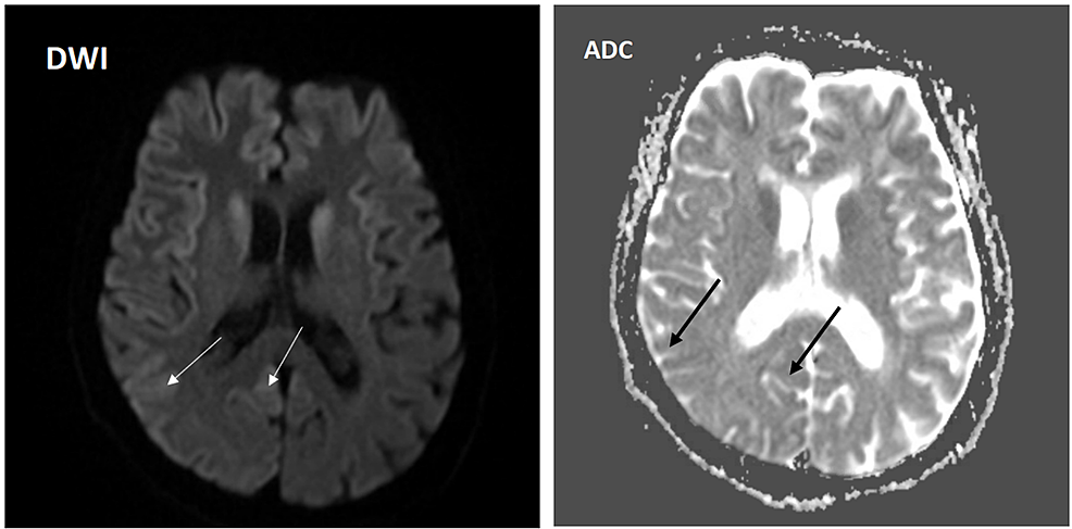 MRI-of-the-brain-showing-diffusion-restriction-areas-within-the-cortical-sulci-of-the-right-temporal-lobe-posteriorly-(arrows)-in-both-DWI-and-ADC-sequences.