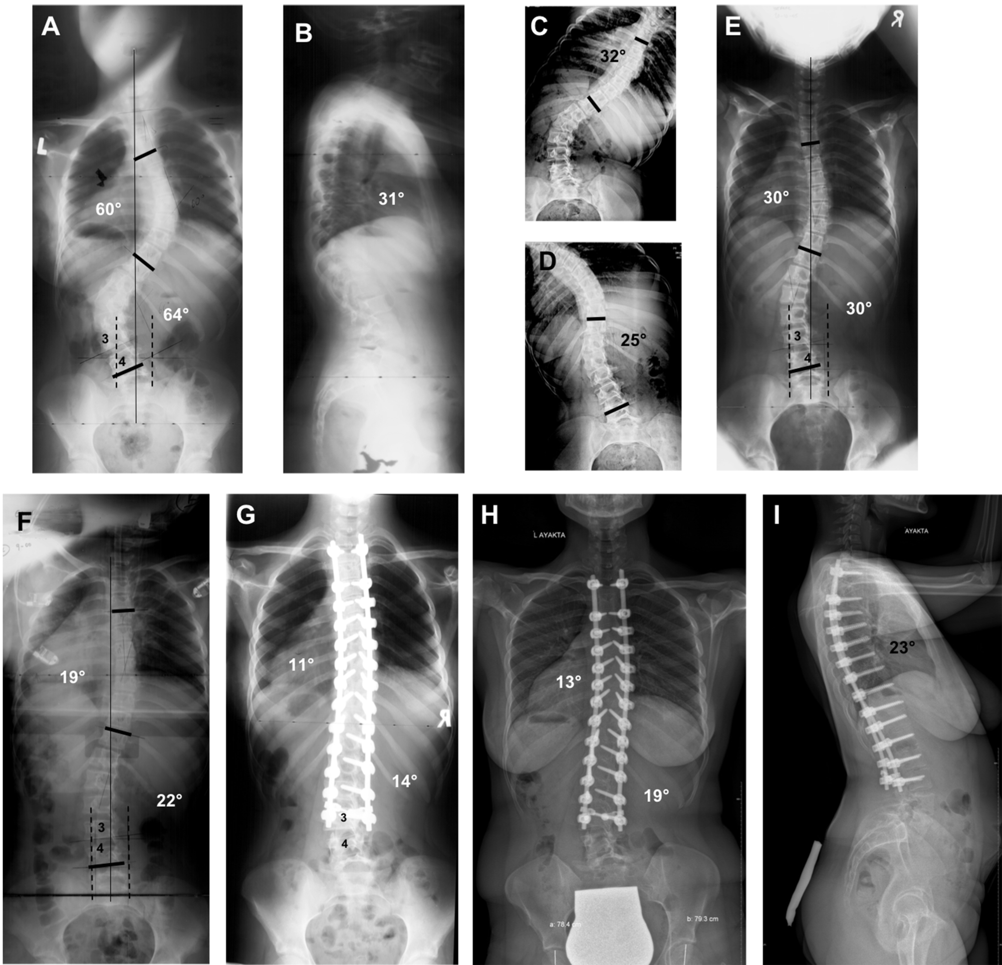 Cureus | Criteria For Ending The Distal Fusion At The L3 Vertebra Vs ...