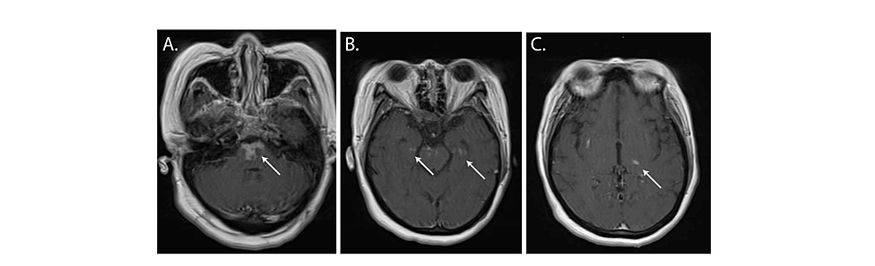 MRI-scan-two-weeks-after-admission-shows-contrast-enhancement.