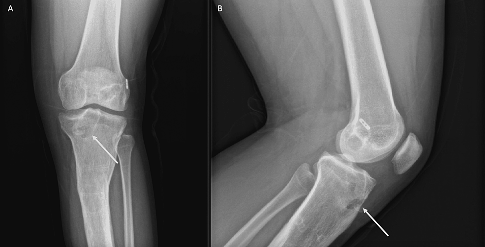 Arthroscopic picture of left knee revealing (a) bulky anterior cruciate