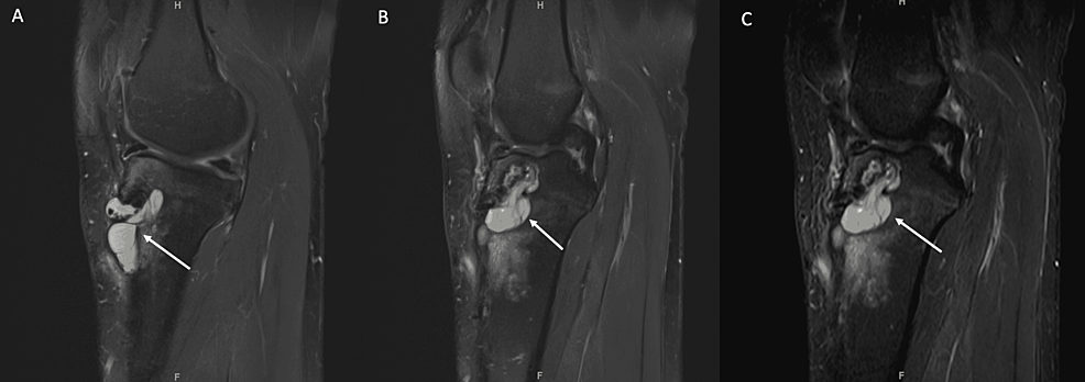 Cureus | Extraarticular Pretibial Synovial Cyst After Arthroscopic ...