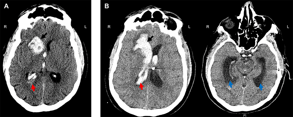 hemorrhagic stroke case study