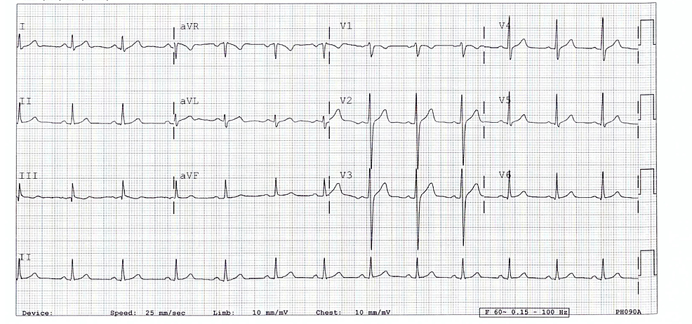 A-normal-electrocardiogram