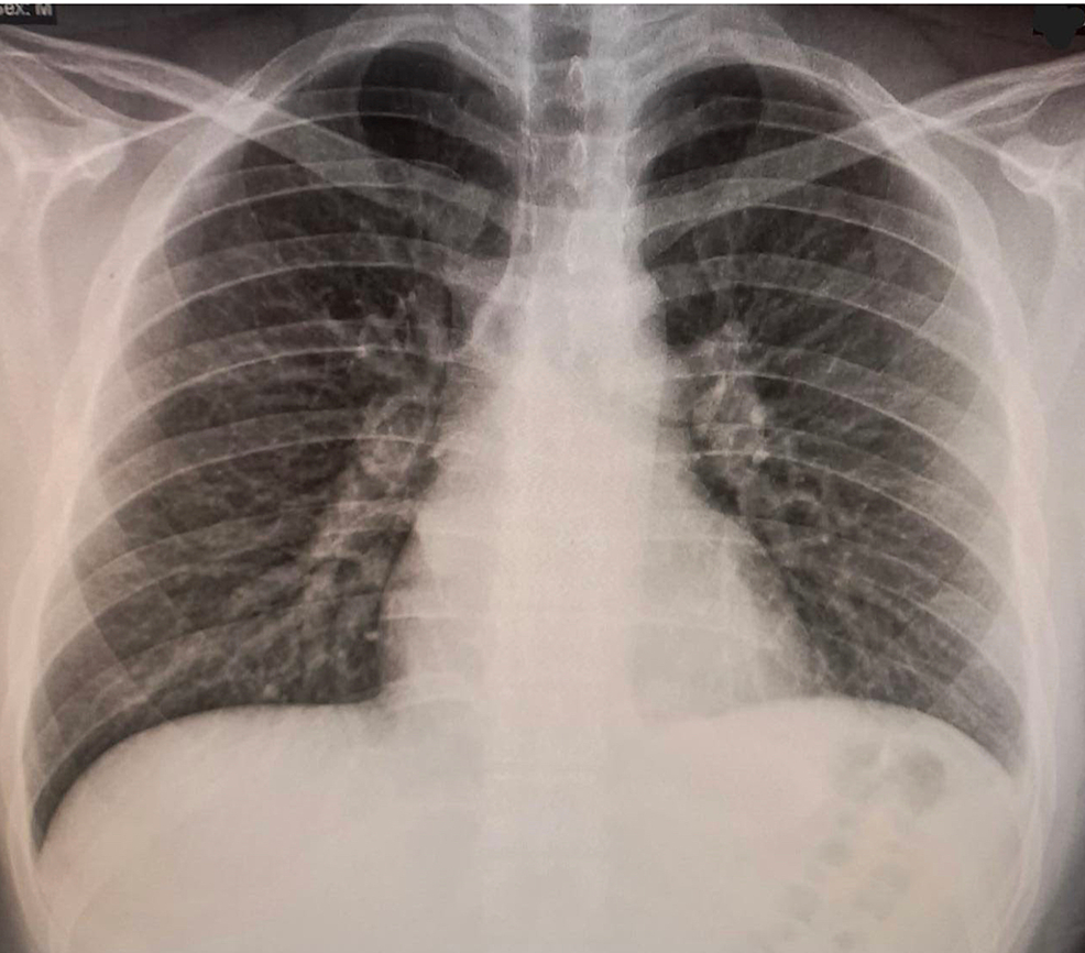 Chest-x-ray-showing-no-abnormal-findings-