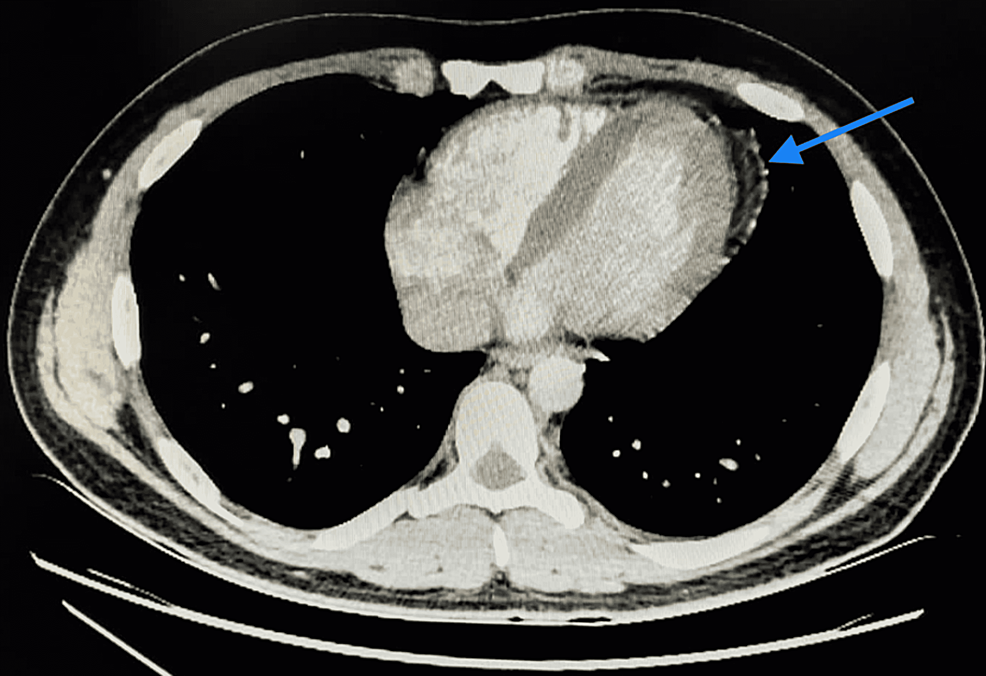 CT-angiocoronal-view-showing-pericardial-fat-stranding-(blue-arrow).