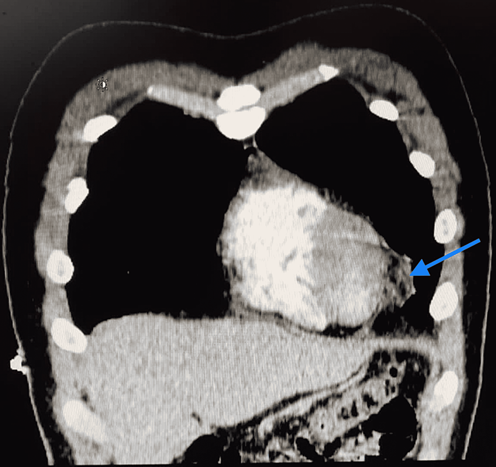 Sagittal-view-of-the-pericardial-fat-stranding-(blue-Arrow)-shown-on-the-CT-angio.