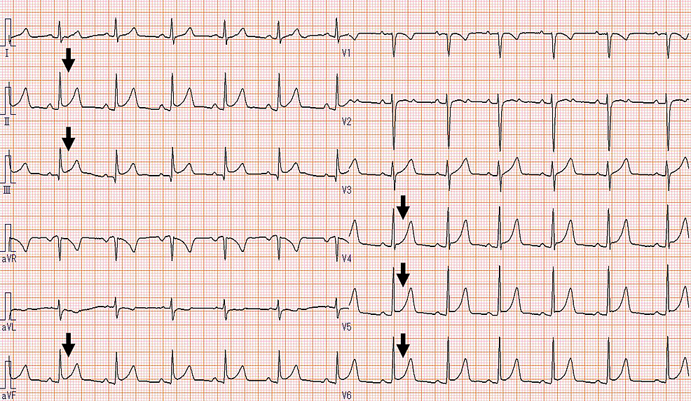 Electrocardiogram-showing-ST-segment-elevation-in-the-II,-III,-aVf,-and-V4–6-leads.