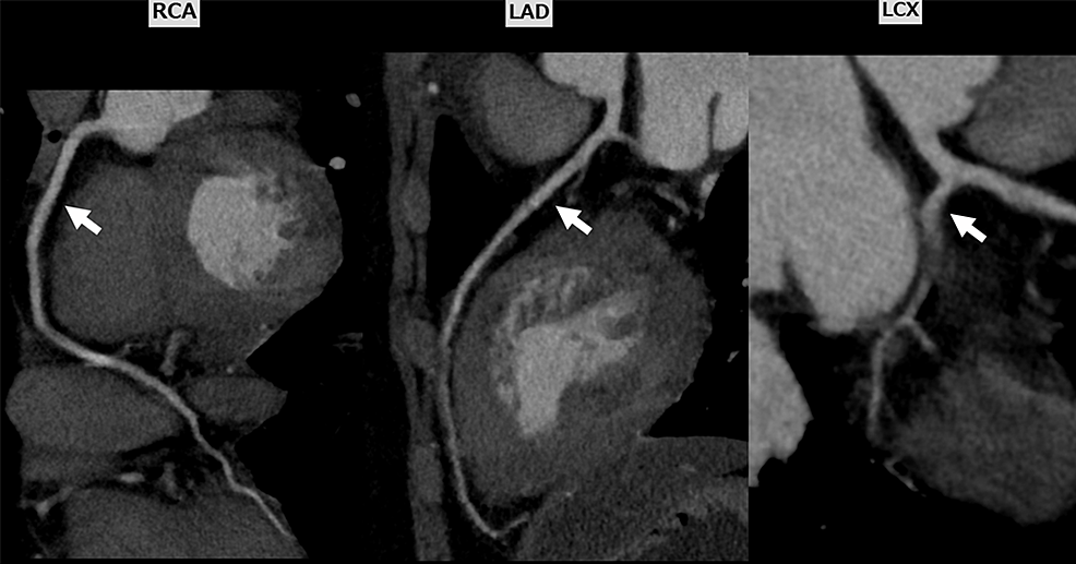 Coronary-computed-tomography-angiography-showing-no-stenosis-of-the-coronary-arteries.