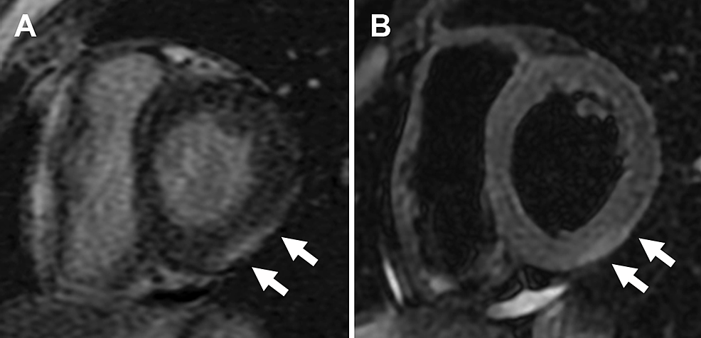 Cardiac-magnetic-resonance-imaging-on-admission.