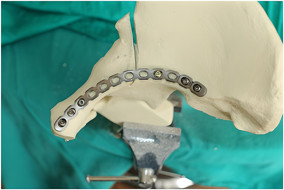 Screw-applied-through-the-ninth-hole-oriented-to-hold-the-posterior-column