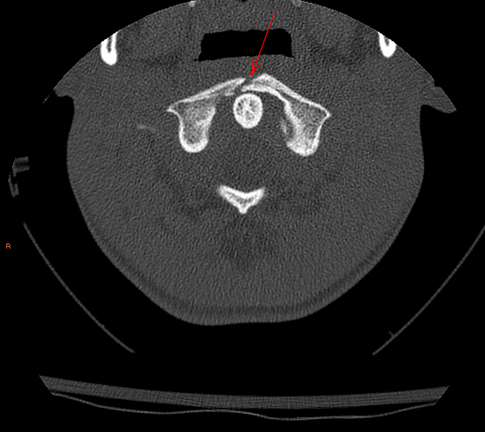 C1-burst-fracture-(anterior)---axial-image