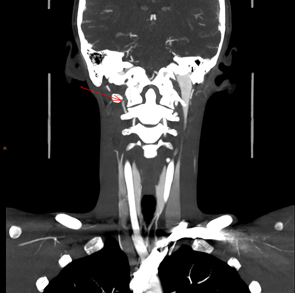 Right-vertebral-artery-occlusion---coronal-image